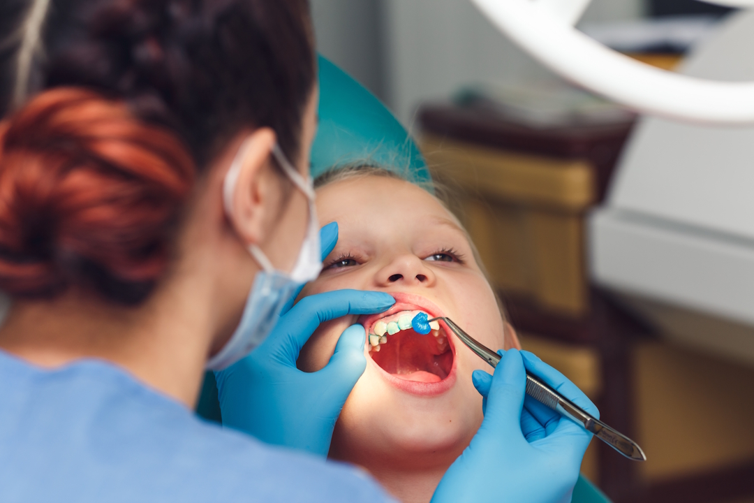 Fluoroprofilassi e Prevenzione Carie a Lugano Fluoroprofilassi e Prevenzione Carie a Lugano