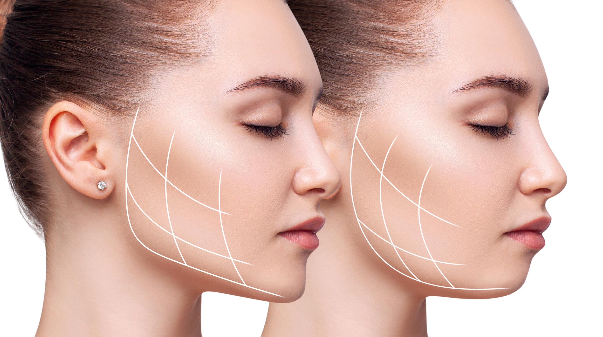 Orthognathic Surgery for Jaw Discrepancies in Lugano | Studio Bakaj Orthognathic Surgery for Jaw Discrepancies in Lugano | Studio Bakaj