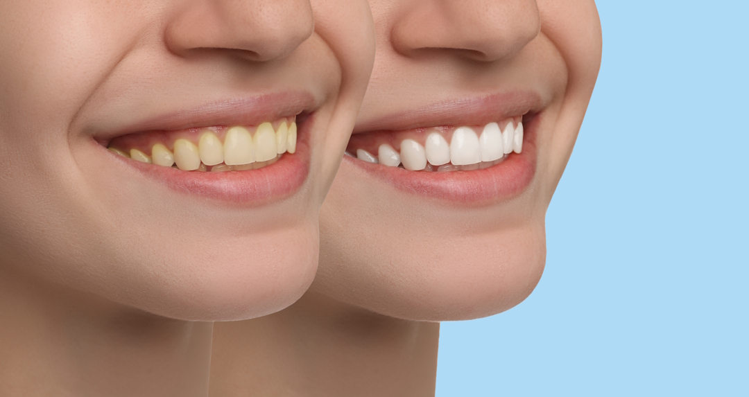 Sbiancamento Dentale Professionale alla Poltrona a Lugano | Studio Bakaj
